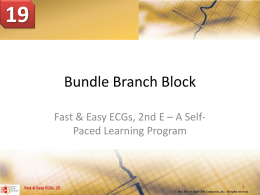 incomplete bundle branch block