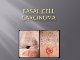 Basal Cell Carcinoma - Menifee County Schools