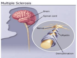 Definition of Multiple Sclerosis