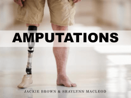 amputations - people.stfx.ca