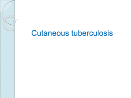 tuberculosis