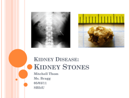 Kidney Disease: Kidney Stones