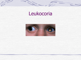 Leukocoria - diabetic retinopathy