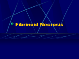 Fibrinoid Necrosis