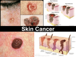 These account for more than 99% of all skin cancers