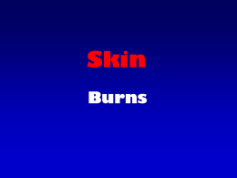 Burns PPT