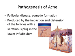 Pathogenesis of Acne