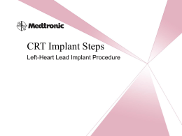 CRT Implant Steps