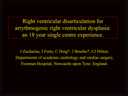 Right Ventricular disarticulation for arrythmogenic right ventricular
