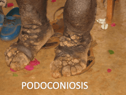 What is Podoconiosis?