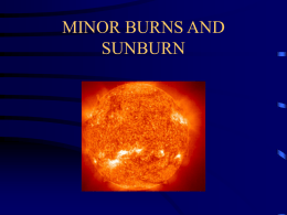 sun burn for students presentation - Home