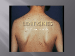 Lentigines - mechalskesbiology