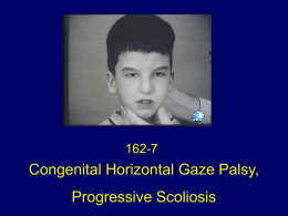 Congenital Horizontal Gaze Palsy Progressive Scoliosis