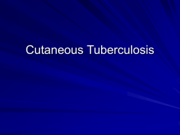 M. tuberculosis